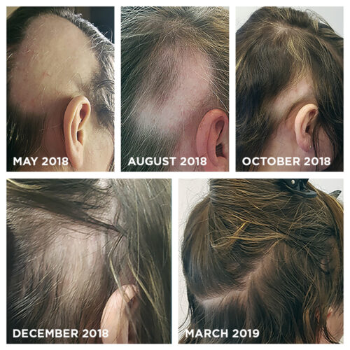 قرص ضد ریزش موی آقایان نورکرین nourkrin man 3 months supply